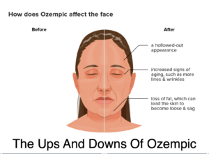 The Ups And Downs Of Ozempic